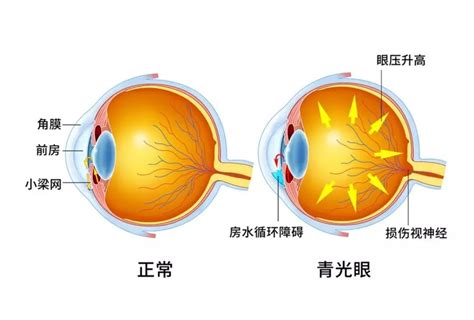 房角|原发性开角型青光眼